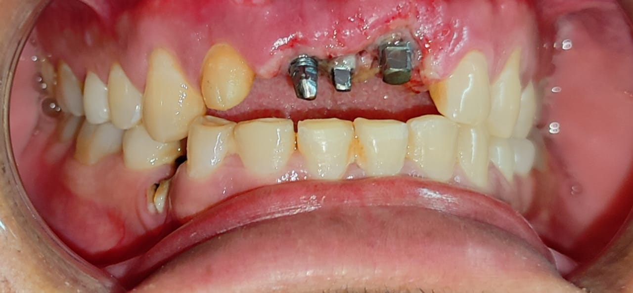 Bridge on dental implants in just 3 days — Implant placement