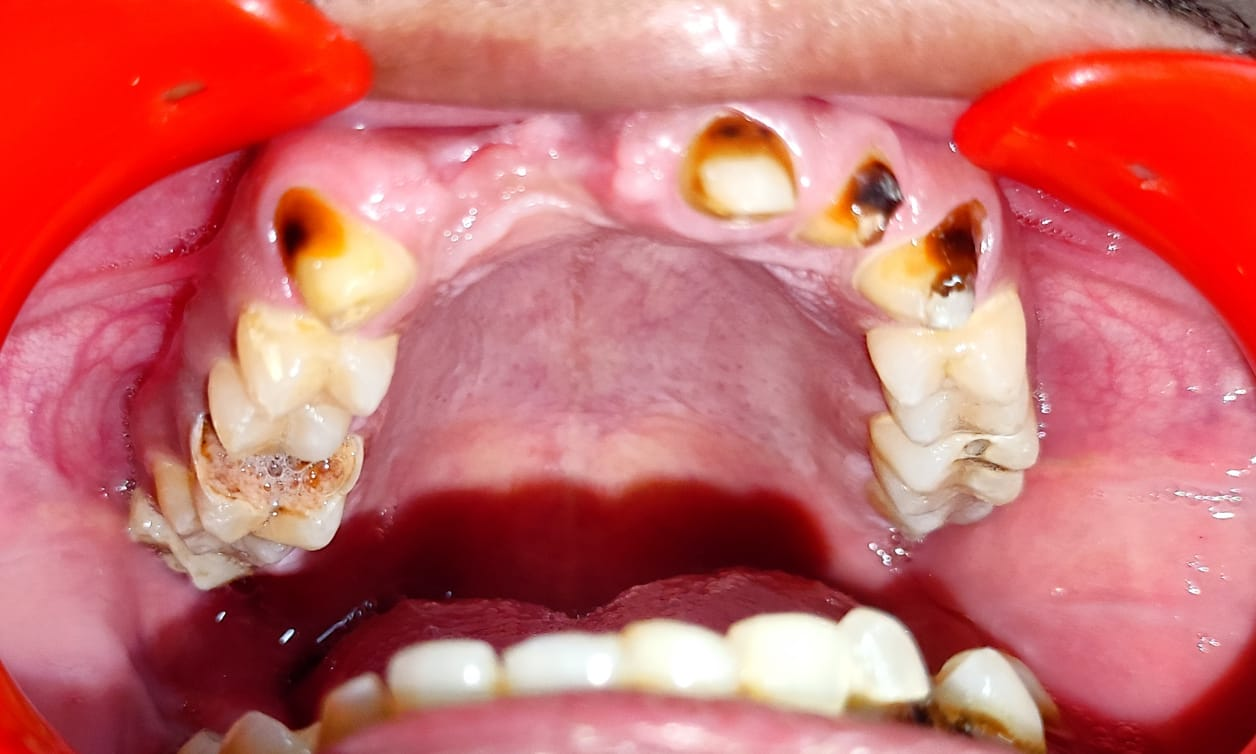 Smile makeover with Zirconia bridge — Patient 2 · Pre Op — after crown preparation, 6 unit