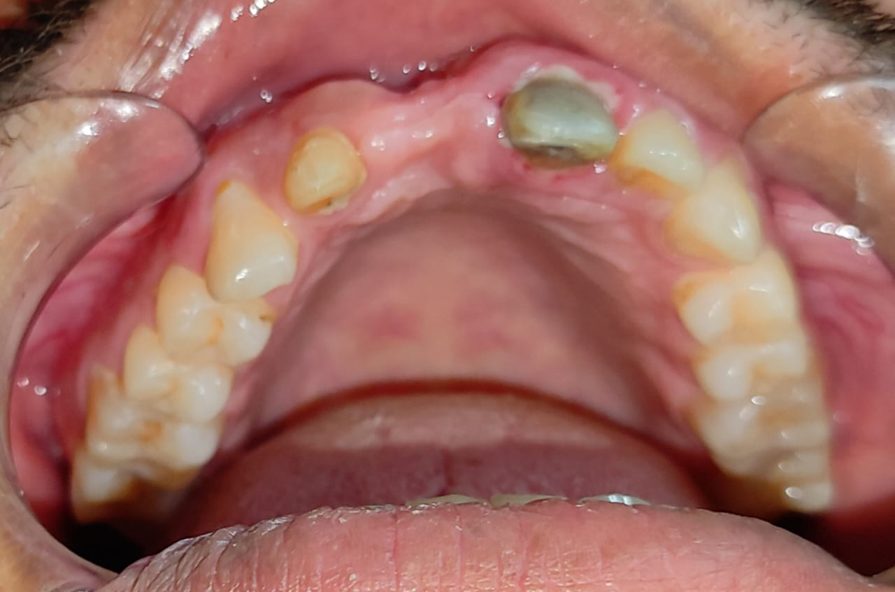 Bridge on dental implants in just 3 days — Pre Op — before implant placement