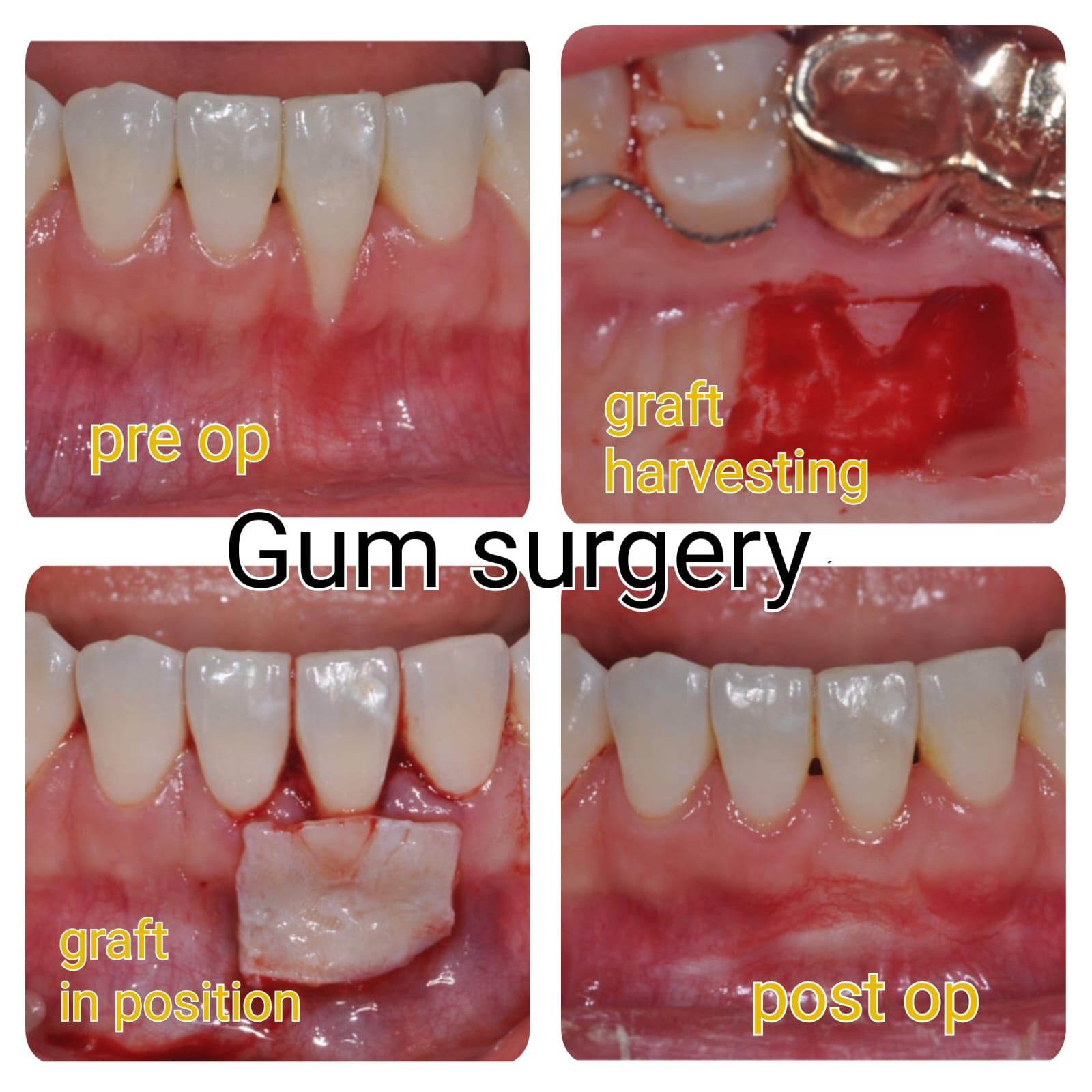 Gum Surgeries & Periodontal Treatment at Mittal Dental Clinic