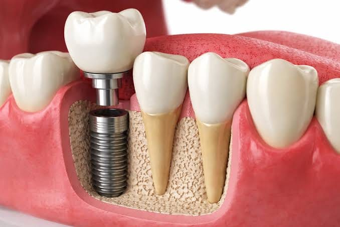 Dental Implants at Mittal Dental Clinic
