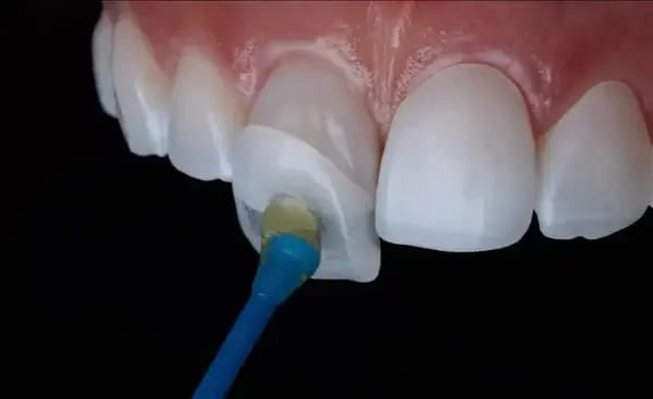 Veneer placement at Mittal Dental Clinic, Indore