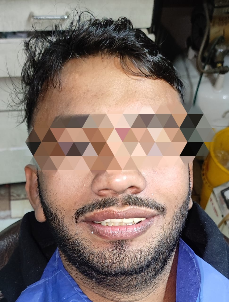 Smile makeover with Zirconia bridge — Patient 2 · Final result — a confident new smile