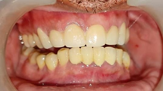 Smile makeover with Zirconia bridge — Patient 1 · Post Op — smile correction after bridge