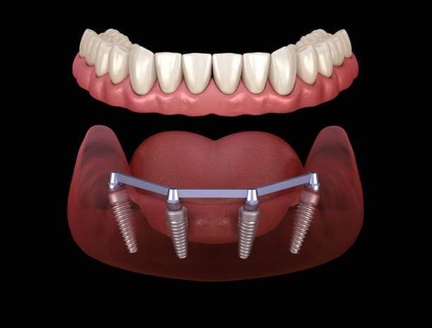 Dental implant pre-op and post-op result