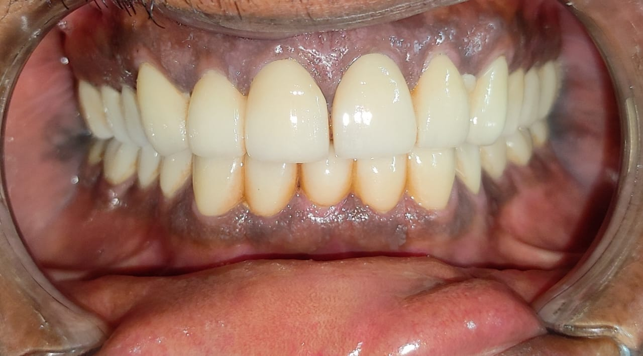 FMR with Zirconia bridges — Pre-op & Post-op — Post-op