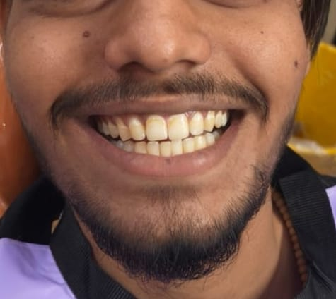 Braces & aligners — Pre-op & Post-op — Post-op