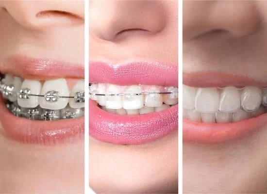 Braces & Aligners at Mittal Dental Clinic, Indore