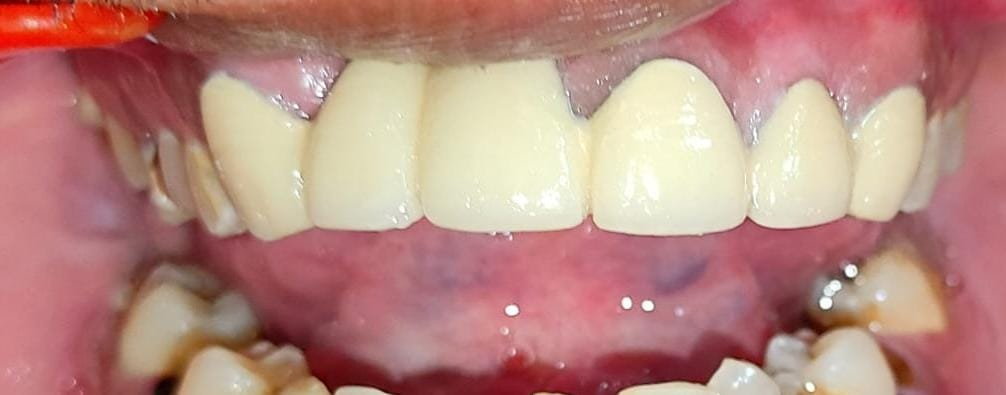 Smile makeover with Zirconia bridge — Patient 2 · Post Op — bridge cementation