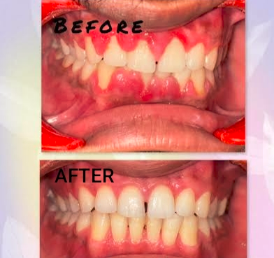 Gum & Laser Dentistry at Mittal Dental Clinic