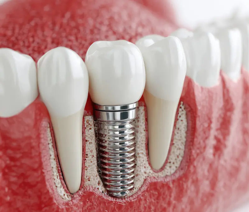 Implants & Gum Care at Mittal Dental Clinic, Indore