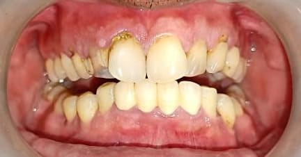 Smile makeover with Zirconia bridge — Patient 1 · Pre Op — before smile makeover