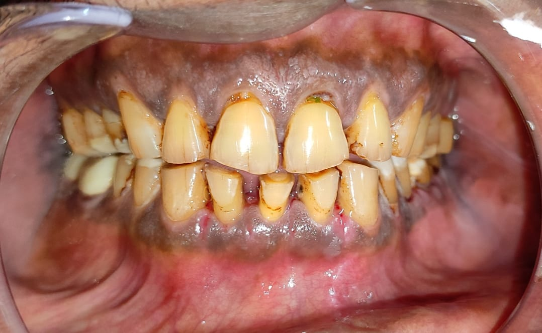 FMR with Zirconia bridges — Pre-op & Post-op — Pre-op