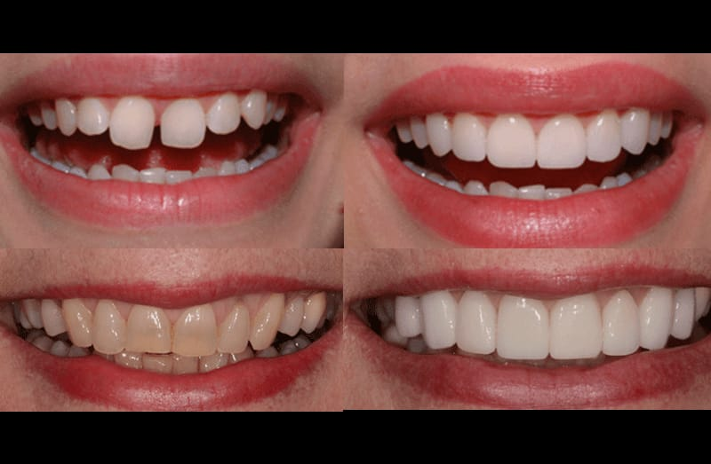 Smile designing with veneers at Mittal Dental Clinic, Indore