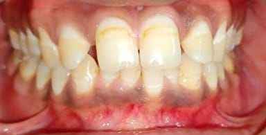 Braces & aligners — Pre-op & Post-op — Pre-op