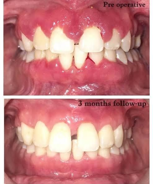 Gum surgery and periodontal care — Pre-op & Post-op — Pre-operative and 3-month follow-up after periodontal treatment