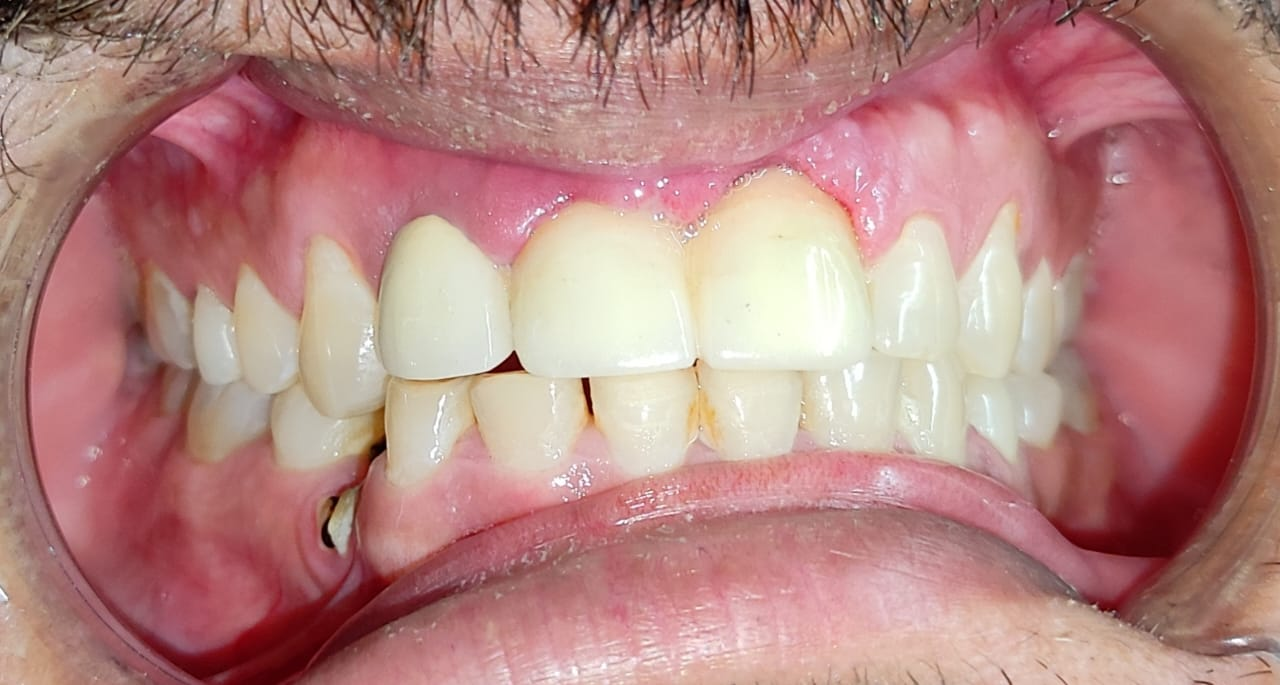 Bridge on dental implants in just 3 days — Post Op — after bridge on dental implants